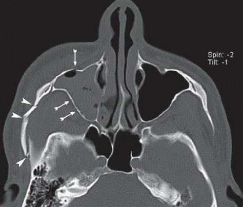 ZMC Fracture | Radiology Key