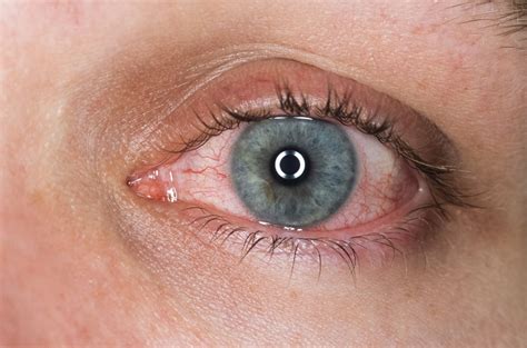 Corticosteroids May Be Overprescribed as Uveitis Treatment - Ophthalmology Advisor