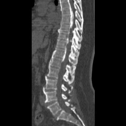 Ankylosing Spondylitis CT Scan