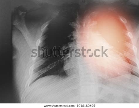 Pulmonary Tuberculosis Chest Xray Interstitial Infiltration Stock Photo 1016180695 | Shutterstock