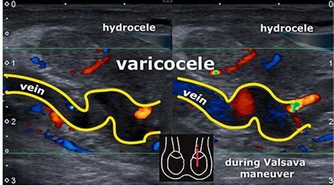 Scrotal Anatomy Ultrasound