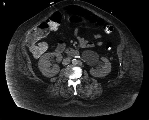 Extrarenal pelvis mimicking hydronephrosis: a case for caution ...