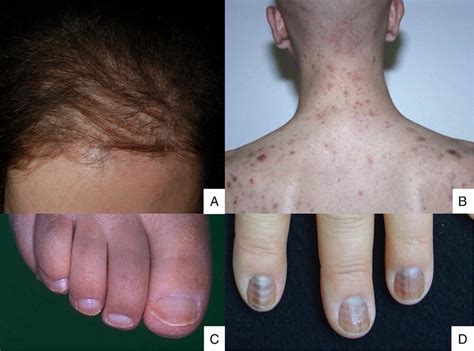 A) Post-chemotherapy alopecia is diffuse, appears in the first few ...