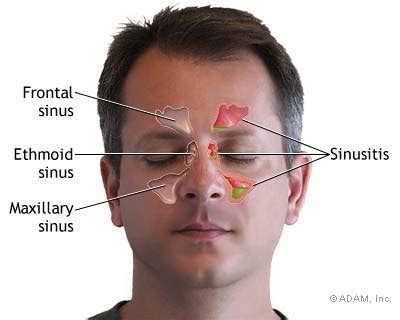 Sinus Symptoms