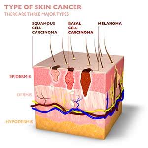 Basal Cell Carcinoma Stages | Moffitt