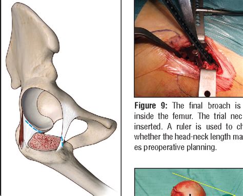 Figure 3 from Anterior Approach in Total Hip Replacement. | Semantic ...