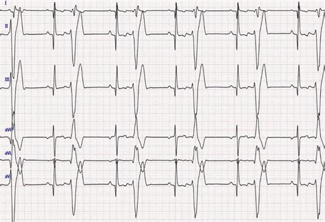 A Vizsla with Ventricular Premature Complexes