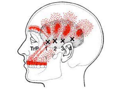 Temporal Headaches | Symptoms, Causes, Treatments