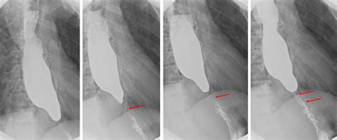 Esophageal stricture: neoplasm – Radiology Cases