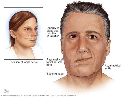 شلل الوجه النصفي - الأعراض والأسباب - Mayo Clinic (مايو كلينك)