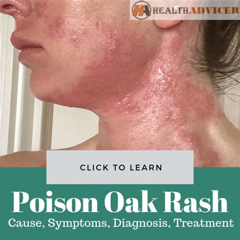 Poison Oak Rash: Causes, Picture, Symptoms and Treatment