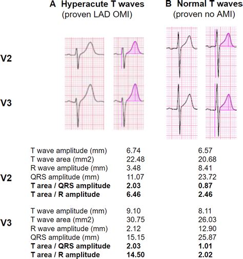 Hyperacute T-waves Can Be a Useful Sign of Occlusion Myocardial ...