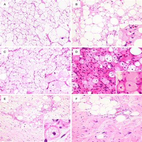 Liposarcoma With Hibernoma-like Histology: A Clinicopatholog... : The ...