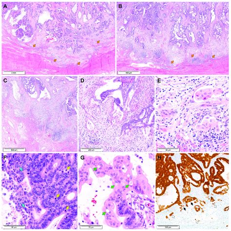 Histological features of MELF pattern in EAC. (A,B) Compared with the... | Download Scientific ...