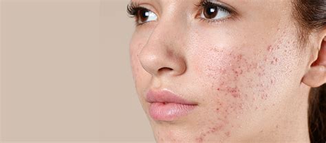 Skin Care: बदलते मौसम में त्वचा का रखना है खास ख्याल, तो मुलतानी मिट्टी पाउडर का ऐसे करें उपयोग ...