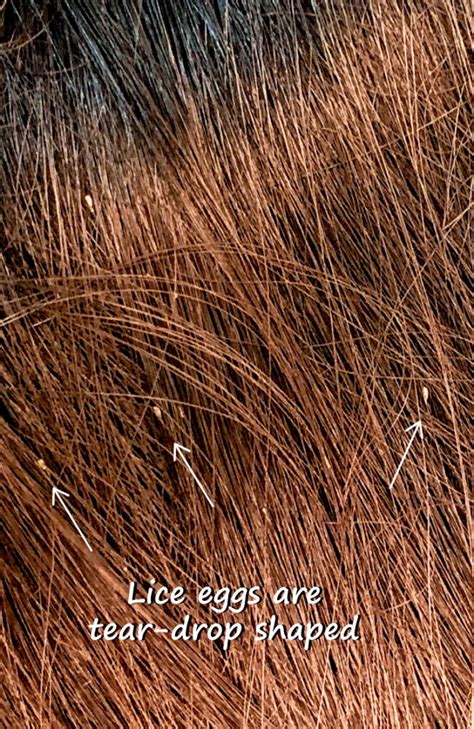 Pictures of What Lice Eggs (Nits) Look Like in Hair: 9 Tips to Spot Them