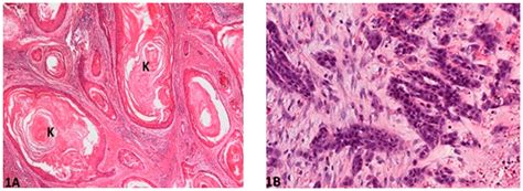 Esophageal Squamous Cell Carcinoma Histology