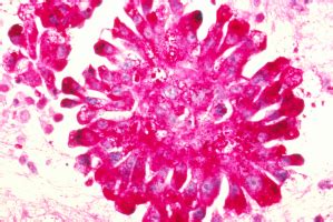 New test provides fast and accurate diagnosis of liposarcomas - ecancer