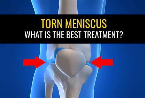 Meniscus Tear Treatment | Torn Meniscus Exercises