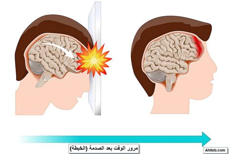 أعراض ارتجاج المخ وعلامات الخطورة ومدة التعافي والعلاج