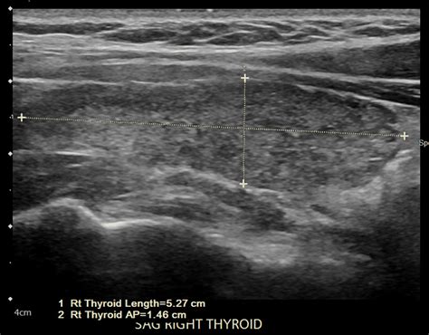 Cureus | Hashimoto's Thyroiditis Encephalopathy Induced by COVID-19 ...