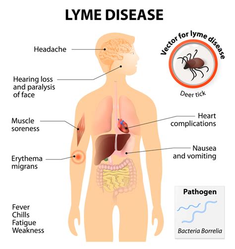 Ignore Lyme Disease Symptoms and You Could Risk Severe Complications - University Health News