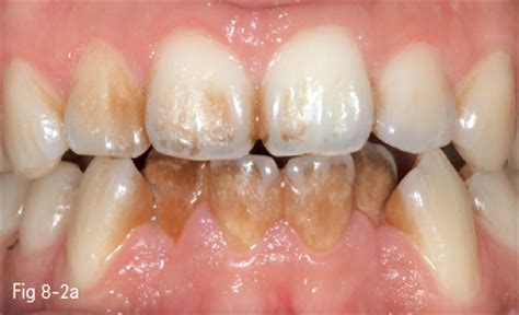 Tooth Discoloration | Pocket Dentistry