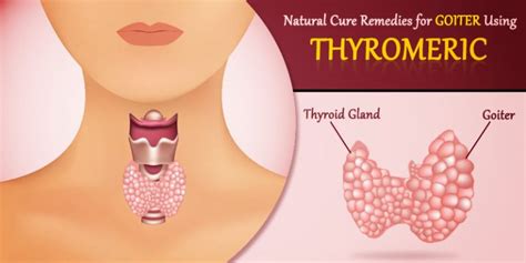 Natural Cure Remedies for Goiter Using Curcumin