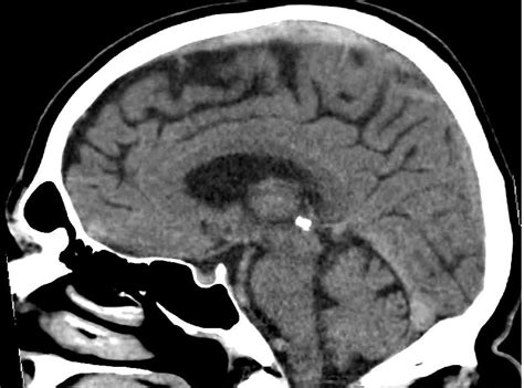 Superior sagittal sinus thrombosis | Image | Radiopaedia.org