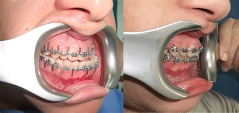 A 21-year-old woman with mandibular prognathism. Preoperative and... | Download Scientific Diagram