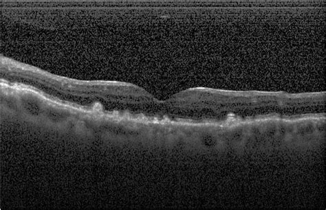 Deep Learning Classification of Drusen, Choroidal Neovascularization ...