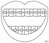 Smile With Braces coloring page  Free Printable Coloring Pages sketch template