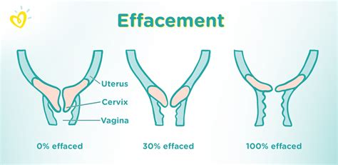 What is Effacement? | Pampers