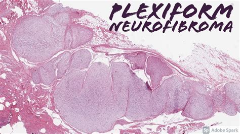 Plexiform Neurofibroma in Neurofibromatosis-1 NF1: 5-Minute Pathology Pearls - YouTube