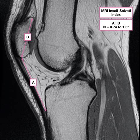 Insall- Salvati Ratio - the ratio of the patella tendon length to the ...