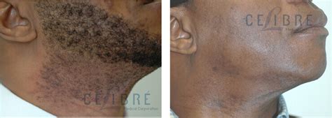 Dark Skin Laser Hair Removal Before and After Picture