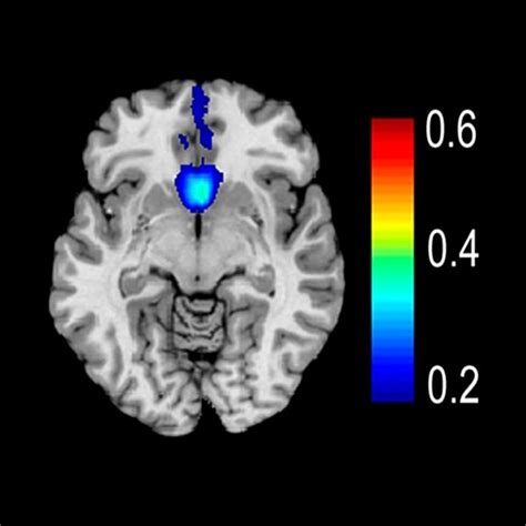 Subgenual Cingulate Cortex (Area 25) | Radiology Key