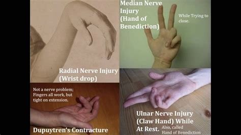 Image result for radial median and ulnar nerve lesions | Nerve problems, Ulnar nerve, Median nerve