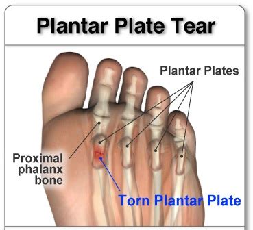 Plantar Plate Tear - A Ball of the Foot Condition - Almawi Limited The Holistic Clinic