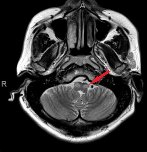 Cureus | Hypertrophic Olivary Degeneration and Movement Disorder in a ...