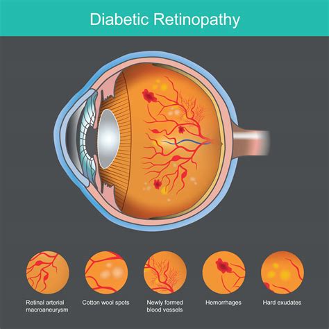 Diabetic Retinopathy | Unitd Doctors Hospital