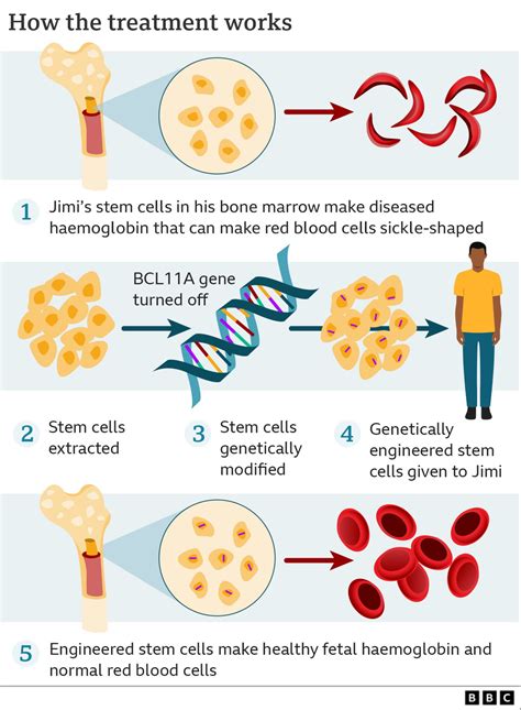 Sickle cell: ‘The revolutionary gene-editing treatment that gave me new ...