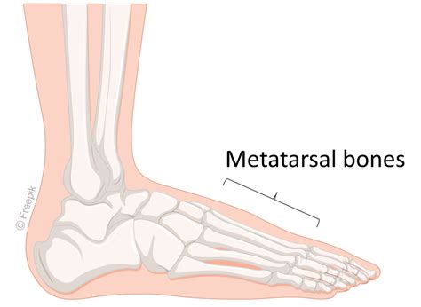 Metatarsal fracture - Kingston Hospital