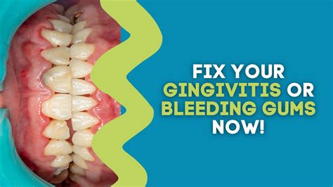 FIX YOUR GINGIVITIS OR BLEEDING GUMS NOW! – The Gut Health Hub