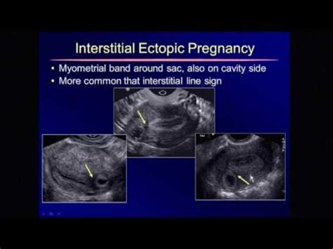 The Term Cornual Pregnancy Should be Abandoned - YouTube