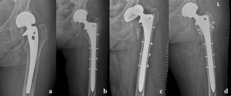 Another case of periprosthetic fracture. An 86-year-old female patient ...