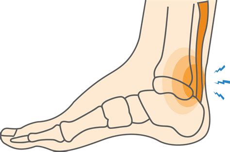 Achilles Tendonitis Symptoms And Treatment Caruso Foot And, 53% OFF