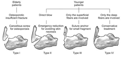 Calcaneal Fracture Classification