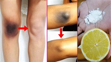 How to Lighten Dark Knees And Elbows Naturally At Home | Dark Knees & Elbows Whitening Home ...