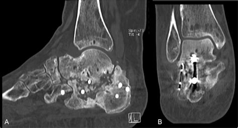 Case 2 Complications. CT scan sagittal (A) and coronal (B) view... | Download Scientific Diagram